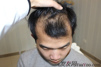 小伙在杭州大麦微针植了发，PUE2200额头+400PTT头顶加密