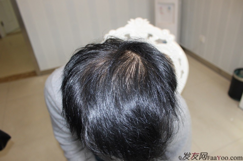 小伙在杭州大麦微针植了发，PUE2200额头+400PTT头顶加密