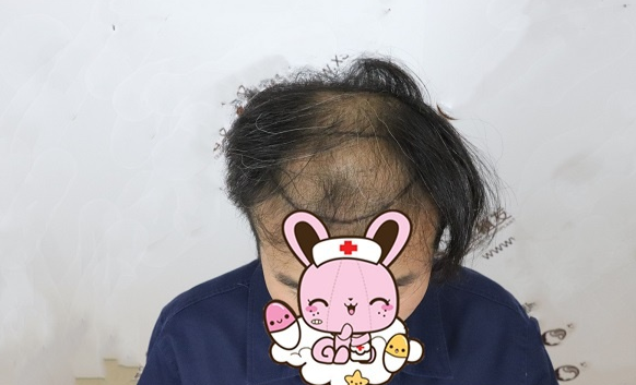 天津真实植发案例，前额植发和头顶加密，术后半年效果分享给大家