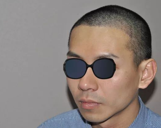 福建福州90后小伙记录植发全过程，看看大额头从大到小
