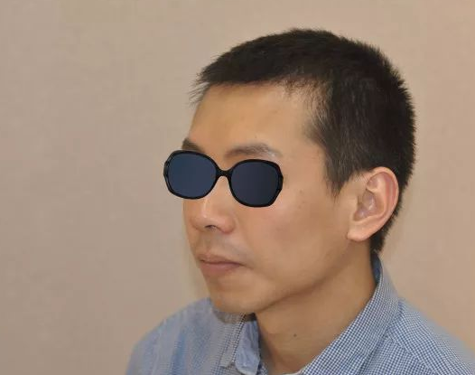 福建福州90后小伙记录植发全过程，看看大额头从大到小