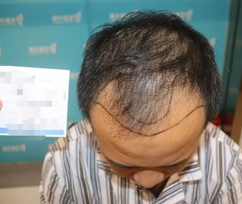 福建泉州程序员秃了？来看看他在雍禾植发效果怎么样