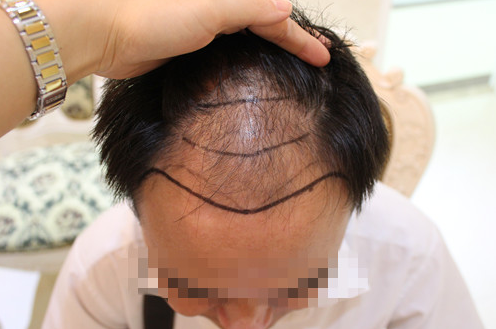 乌鲁木齐植发案例，无痕种植毛囊术后效果