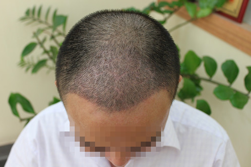 乌鲁木齐植发案例，无痕种植毛囊术后效果