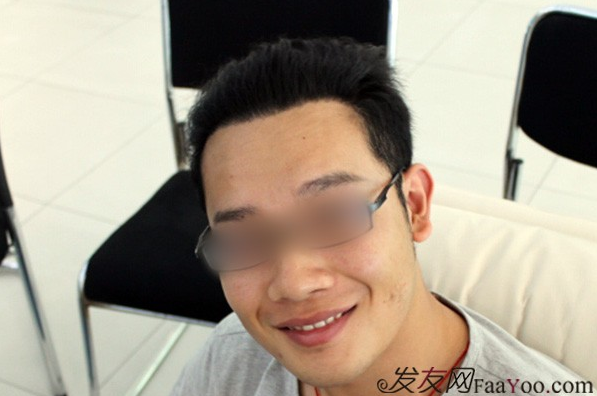 北京雍禾植发3200单位，额头变小了，发际线也出现了，我又变得帅气了