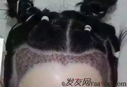 北京真实案例告诉你植发效果怎么样？看看一年后的效果