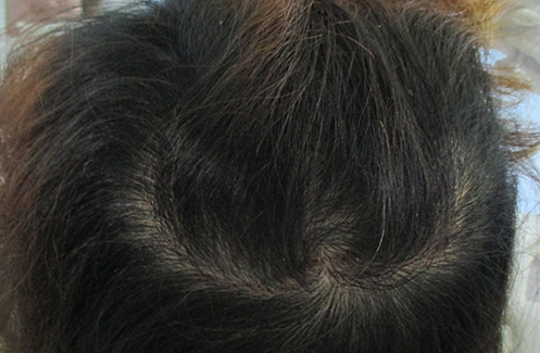 苏州植发医院，遗传性脱发采用FUE加密技术种植1100毛囊单位