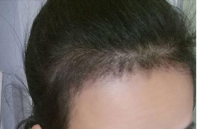 植发多少钱?植发效果如何?