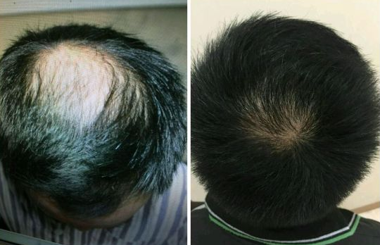 南京的植发价格是多少?价格怎么计算