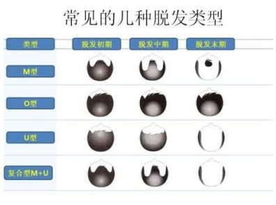 哈尔滨市哪里有植发的