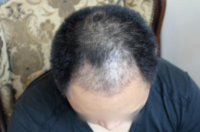 石家庄的植发价格,手术价格高低受什么影响变化?