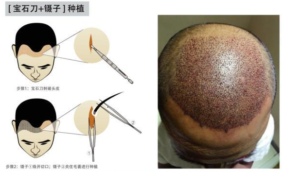 兰州植发多少钱