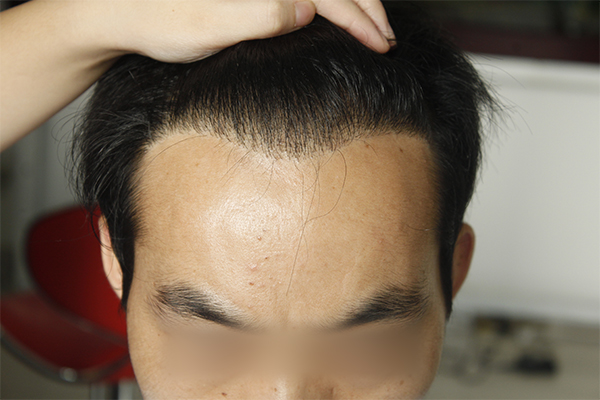 发际线植发能维持多久