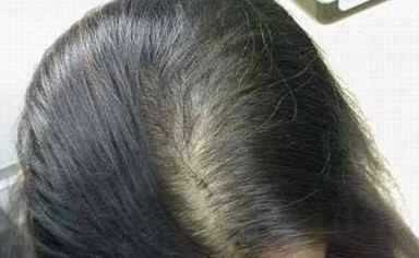 丽江一般的植发的价格如何?会不会很贵