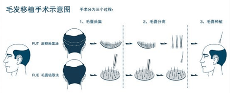 南京植发价格一般多少钱