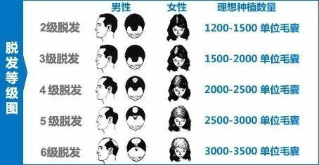 石家庄植发效果好的医院有哪些,费用是多少?
