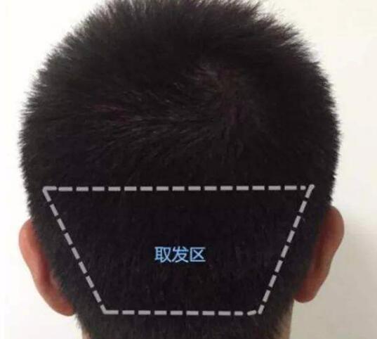 天津植发效果好的医院有哪些,费用是多少?