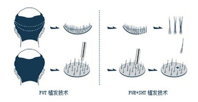 重庆植发效果好的医院有哪些,费用是多少?
