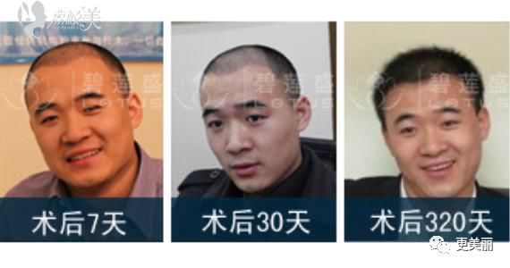 广州植发效果好的医院有哪些,费用是多少?