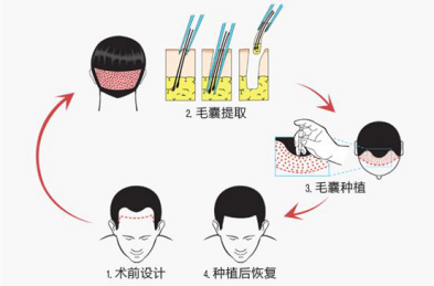 杭州植发贵吗,有哪些效果好的医院推荐?