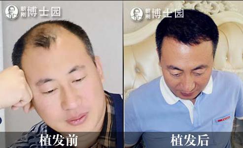 沈阳哪家植发医院能让发友更好的提高自身形象,需要多少费用?