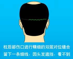 西安有哪些排名靠前、可靠的植发医院?