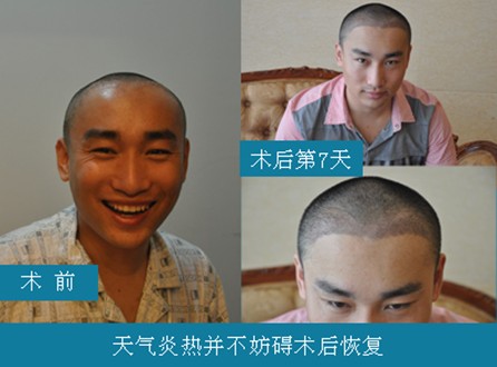 成都雍禾植发医院怎么样,发友最新口碑评价