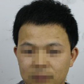 南昌植发手术需要多少费用,我在南昌植发2000个毛囊效果分享