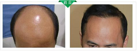 看我在杭州新生植发效果怎么样？植发有什么危害和后遗症吗？