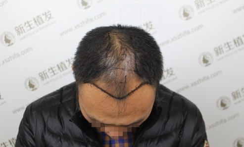 我在杭州新生种植毛发3500单位，已经术后一个月了