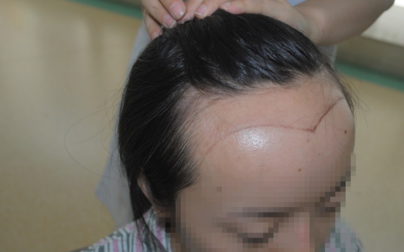 去成都雍禾进行无痕植发手术，女生植发发际线2200单位分享