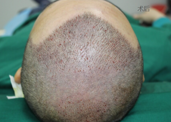 脱发四级，在济南大麦微针植发医院做了手术看看我的效果还有心理经历