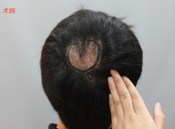 广州新发现疤痕植发，给大家分享我奇迹的术后效果