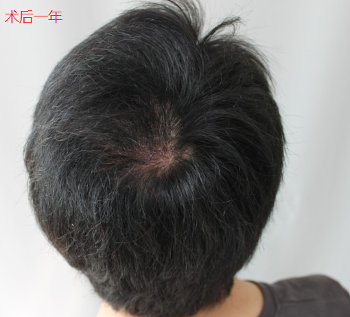 广州新发现疤痕植发，给大家分享我奇迹的术后效果