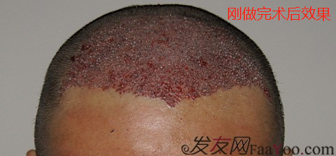 北京盛发园三级植发案例，植发8个小时术后效果