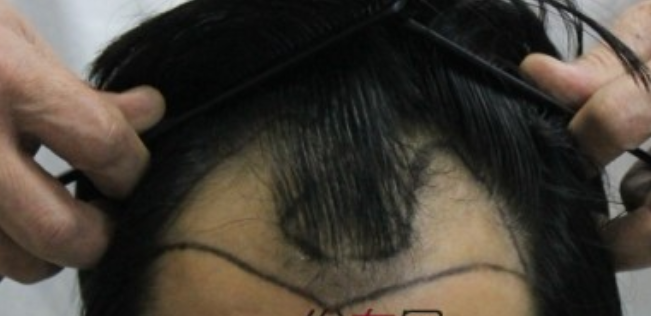 我在杭州时光植发机构，种头发2000多单位看看术后效果怎么样