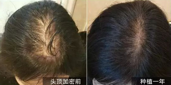 女性植发手术效果怎么样呢？上海新生植发头顶加密2500单位