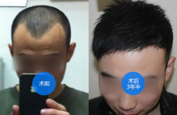 南京大麦微针做完植发手术三年后，来给大家分享经验