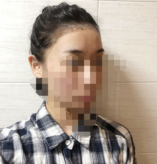 发际线种植2000毛囊