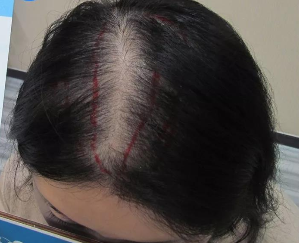头顶发缝稀疏宽大用植发技术可以改善吗？有风险吗？