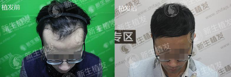 广州新生植发怎么样？李先生亲自分享本人真实植发案例