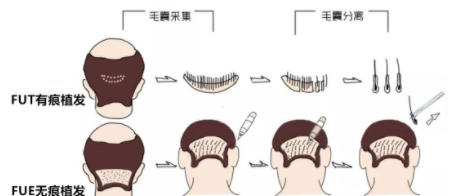 FUT和FUE植发有什么区别？哪种技术更加先进？