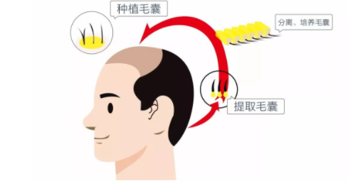 FUT和FUE植发有什么区别？哪种技术更加先进？