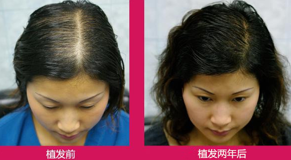植发前需要注意到哪些问题，植发真的不会掉吗？