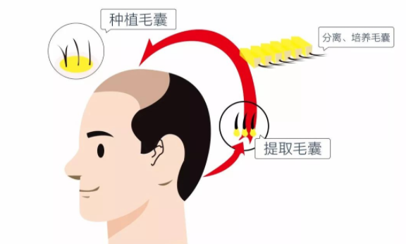 植发百科：每个人都理解的1个毛囊=1根头发？毛囊误区！