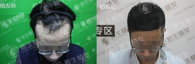 广州新生医疗美容门诊部怎么样?附价格表及真人植发过程图