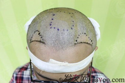 广州新生植发医院正不正规?新生植发真实测评