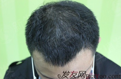 广州新生植发医院正不正规?新生植发真实测评