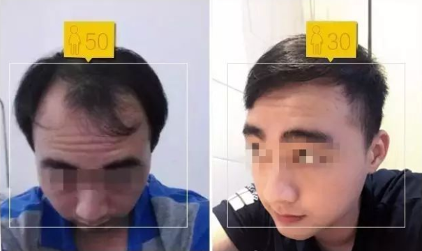 广州微雨医院植发效果图，来看看怎么样~