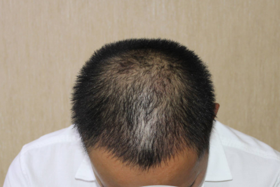 南京大麦微针植发医院正规吗?附男士头顶加密植发5个月效果情况!